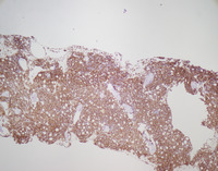 Bone marrow trephine biopsy