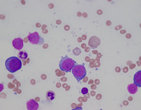 Bone marrow aspirate 3