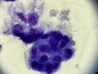 Lung cancer metastasis to pleural fluid 1