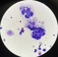 Lung cancer metastasis to pleural fluid 2