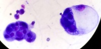 Lung cancer metastasis to pleural fluid 4