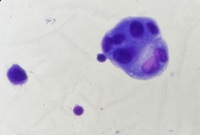 Lung cancer metastasis to pleural fluid 6