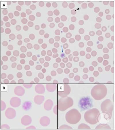 Macrothrombocytopenia in DiGeorge Syndrome (del 22q11.2)