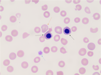 Peripheral Blood Smear of a Peripartum patient with Thrombotic Thrombocytopenic Purpura