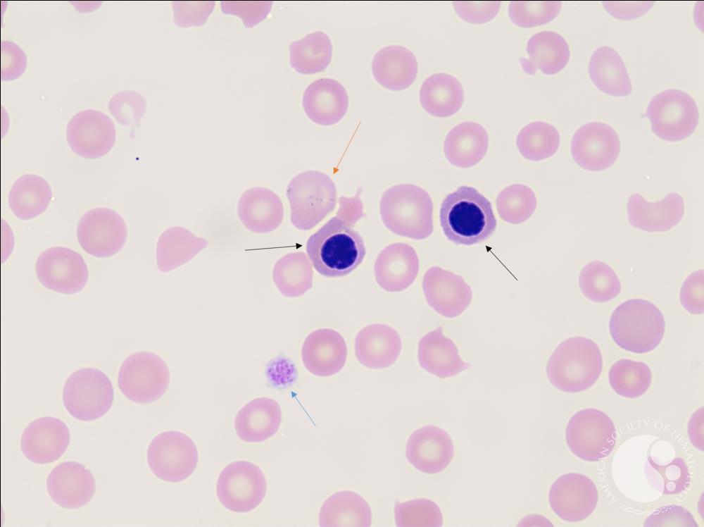 Peripheral Blood Smear of a Peripartum patient with Thrombotic Thrombocytopenic Purpura