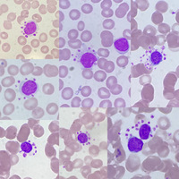 Lymphocytic Platelet Satellitism