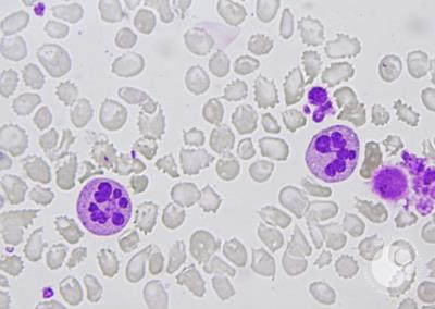 neutrophils with botryoid nuclei