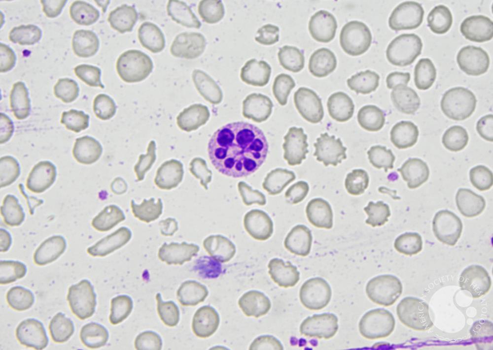 Botryoid neutrophil