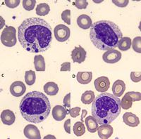 Pseudo Pelger Huet Anomaly With Howell Jolly Like Inclusions In Granulocytes 7174