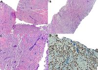 Azzopardi Phenomenon in Diffuse Large B-cell Lymphoma