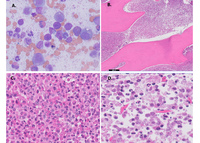 Charcot-Leyden Crystals in the Bone Marrow Biopsy of a Patient with a Myeloid Neoplasm with Eosinophilia and PDGFRB Rearrangement