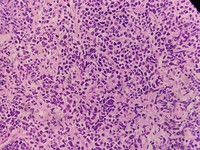 Bone marrow biopsy in high power showing immature lymphoid cells with irregular nuclear contours