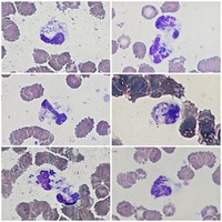 macrophage with hemosiderin