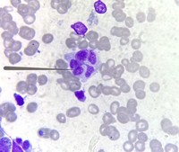 Botryoid neutrophil - In a scrub typhus case