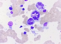 Botryoid neutrophil