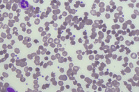 Alectinib Induced Haemolytic Anaemia