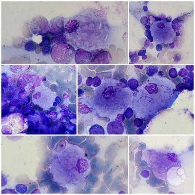 Gaucher cell disease 1