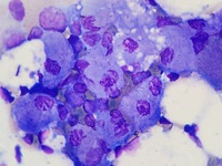 Gaucher cell disease 2
