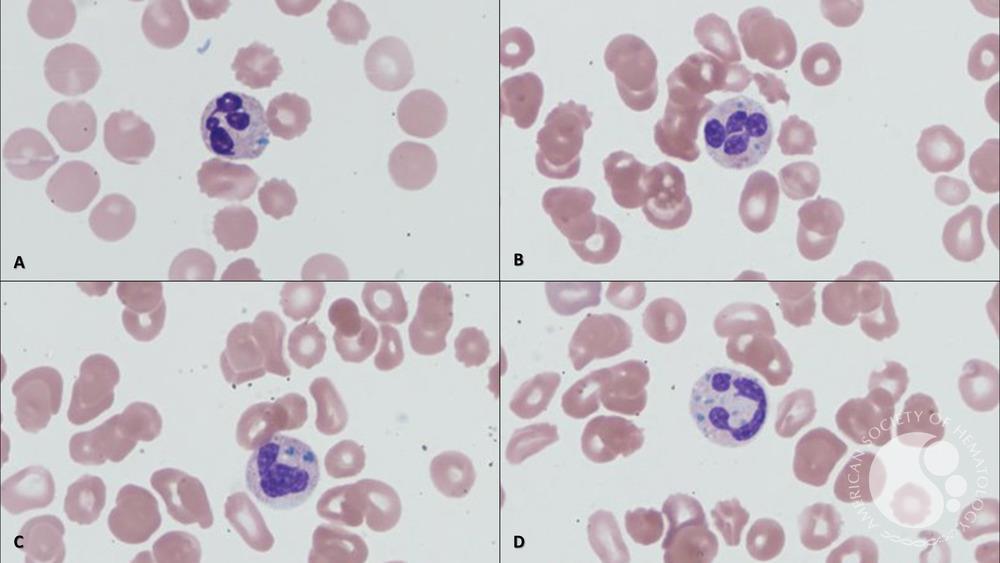 Green neutrophilic and monocytic inclusions as a dire prognostic indicator for clinical outcome.
