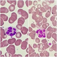 Hypersegmented neutrophils