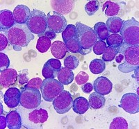 Acute Erythroid Leukemia (AML M6)