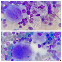 Gaucher's disease