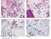 CD31 (+) Positive Plasma Cells