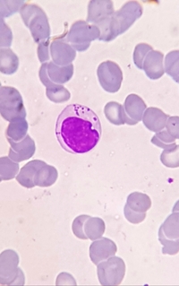 Large granular lymphocyte (LGL)