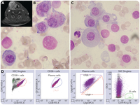 An unusual case of a multiple myeloma with thyroid involvement at primary diagnosis