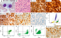 BRAF-negative, CD103-negative hairy cell leukemia