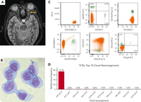 Hepatosplenic T-cell lymphoma with STAT5B and SETD2 mutations recurring as cells with NK-cell immunophenotype