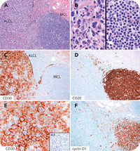 Composite ALK-negative anaplastic large-cell lymphoma and mantle cell lymphoma