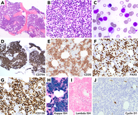 Lymphoplasmacytic lymphoma with IgG paraprotein and extensive plasmacytic differentiation mimicking plasma cell neoplasm