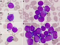 Cuplike nuclei in B-cell acute lymphoblastic leukemia with DUX4 rearrangement