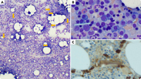 Multiple myeloma presenting with extracellular crystal deposition in the bone marrow