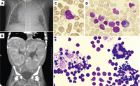 Blast phagocytosis