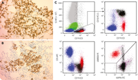 κ light chain–expressing hematogones in a patient with λ-restricted CLL and multiple myeloma on daratumumab therapy