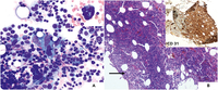 Metastatic angiosarcoma in a bone marrow biopsy