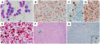 Effusion presentation of HHV-8–associated multicentric Castleman disease mimicking primary effusion lymphoma