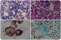 Metastatic carcinoma mimicking hemophagocytic lymphohistiocytosis