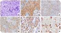 ALK-positive large B-cell lymphoma, a rare B-cell lymphoma expressing ALK