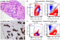 False CD10 positivity in MALT lymphoma involving kidney