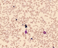 Hereditary Pyropoikilocytosis