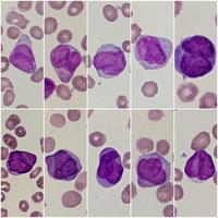 Blasts in APL hypogranular