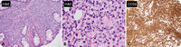 indolent t cell lymphoma of the gi tract