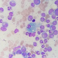 Pseudo-Gaucher cell in Chronic Myeloid Leukemia