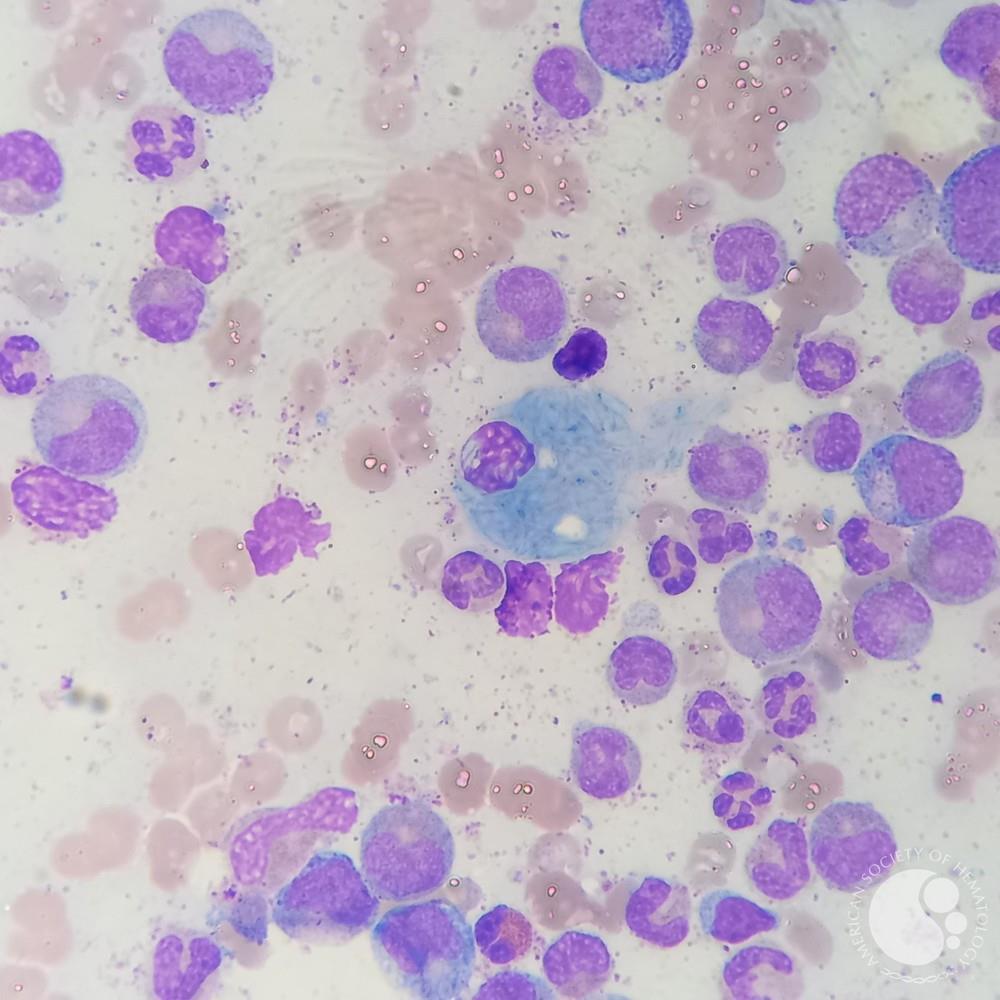 Pseudo-Gaucher cell in Chronic Myeloid Leukemia