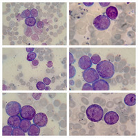 Hypergranulated Acute Promyelocytic Leukemia