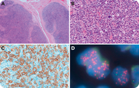 ALK-negative anaplastic large cell lymphoma with JAK2 rearrangement mimicking classic Hodgkin lymphoma