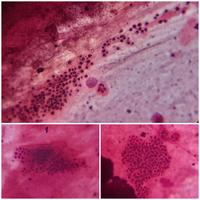 Pneumocystis 1